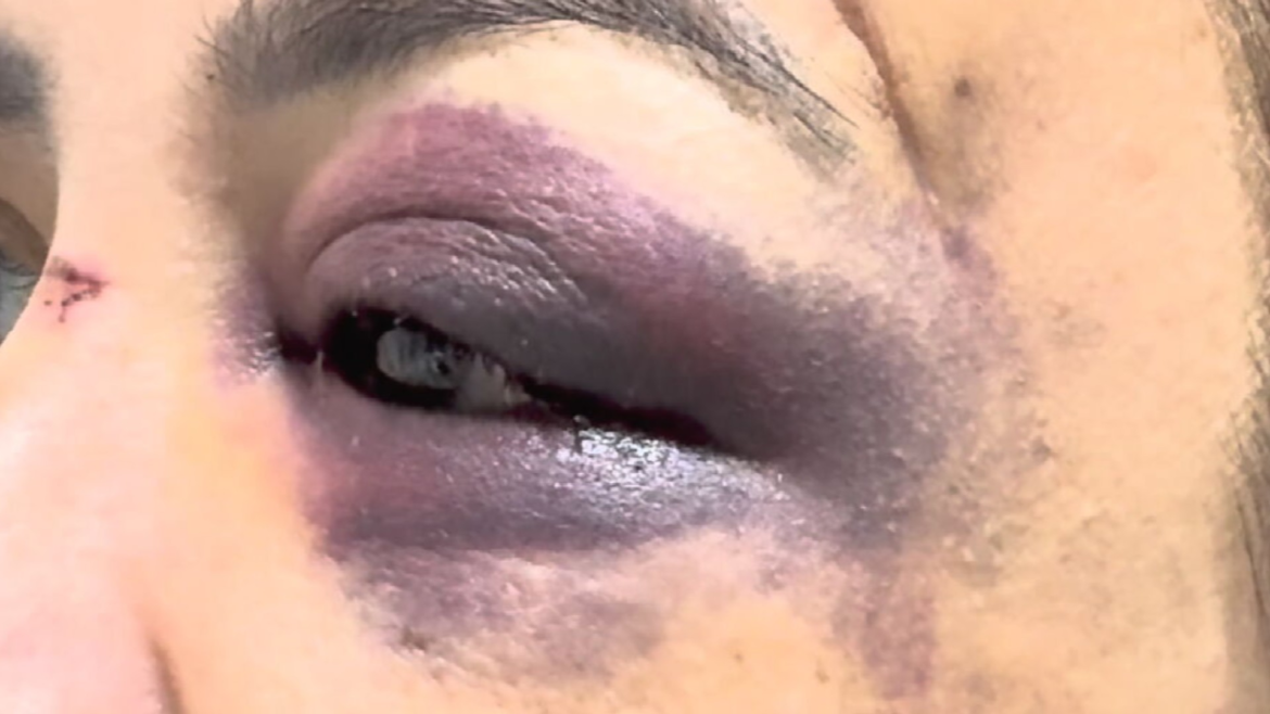 mulher-chicoteada-com-fio-eletrico-pelo-marido-diz-que-foi-espancada-no-mesmo-dia-em-que-teve-alta-apos-primeira-agressao:-‘medo-de-morrer’