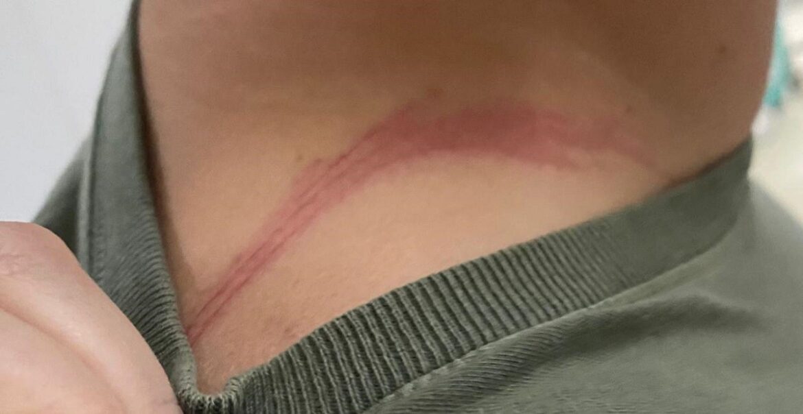 correntinha-que-ladrao-roubou-e-engoliu-em-bh-custa-r$-20-mil,-diz-vitima;-objeto-ainda-nao-foi-expelido