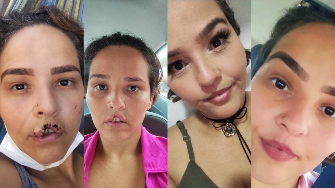 mulher-que-teve-labio-arrancado-por-chow-chow:-o-que-se-sabe-sobre-o-caso-e-proximos-passos