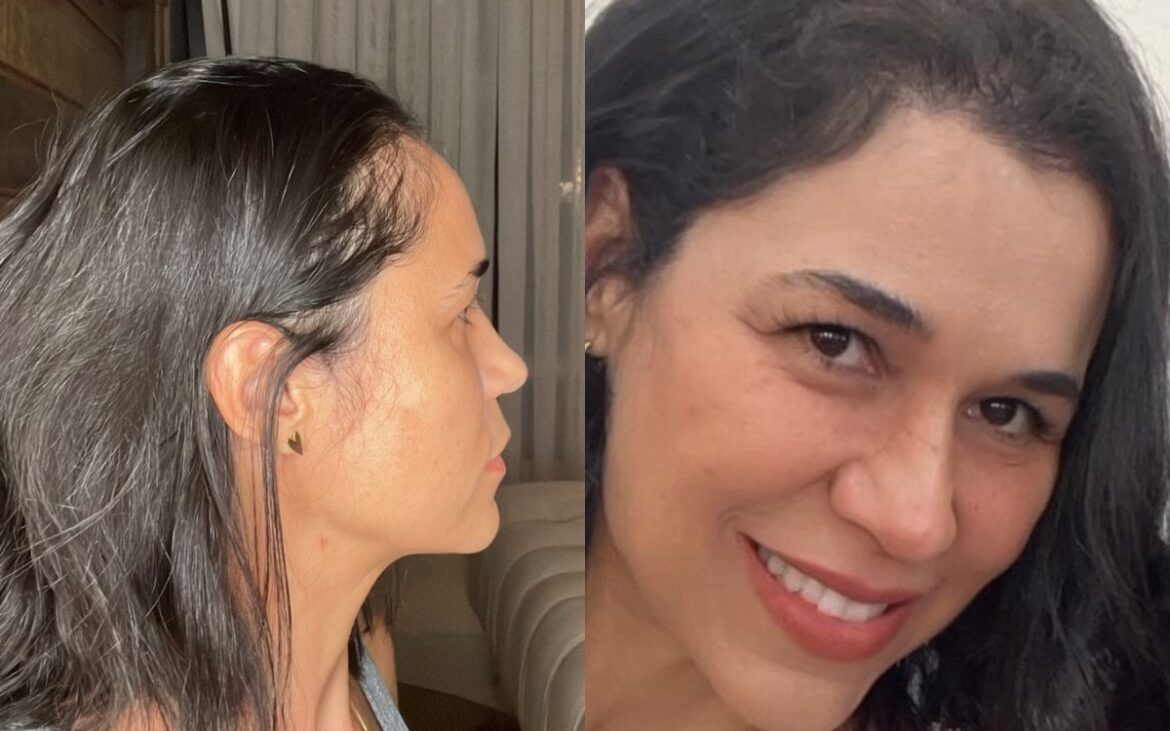 alopecia-e-autoestima:-transplante-capilar-e-alternativa-para-homens-e-mulheres