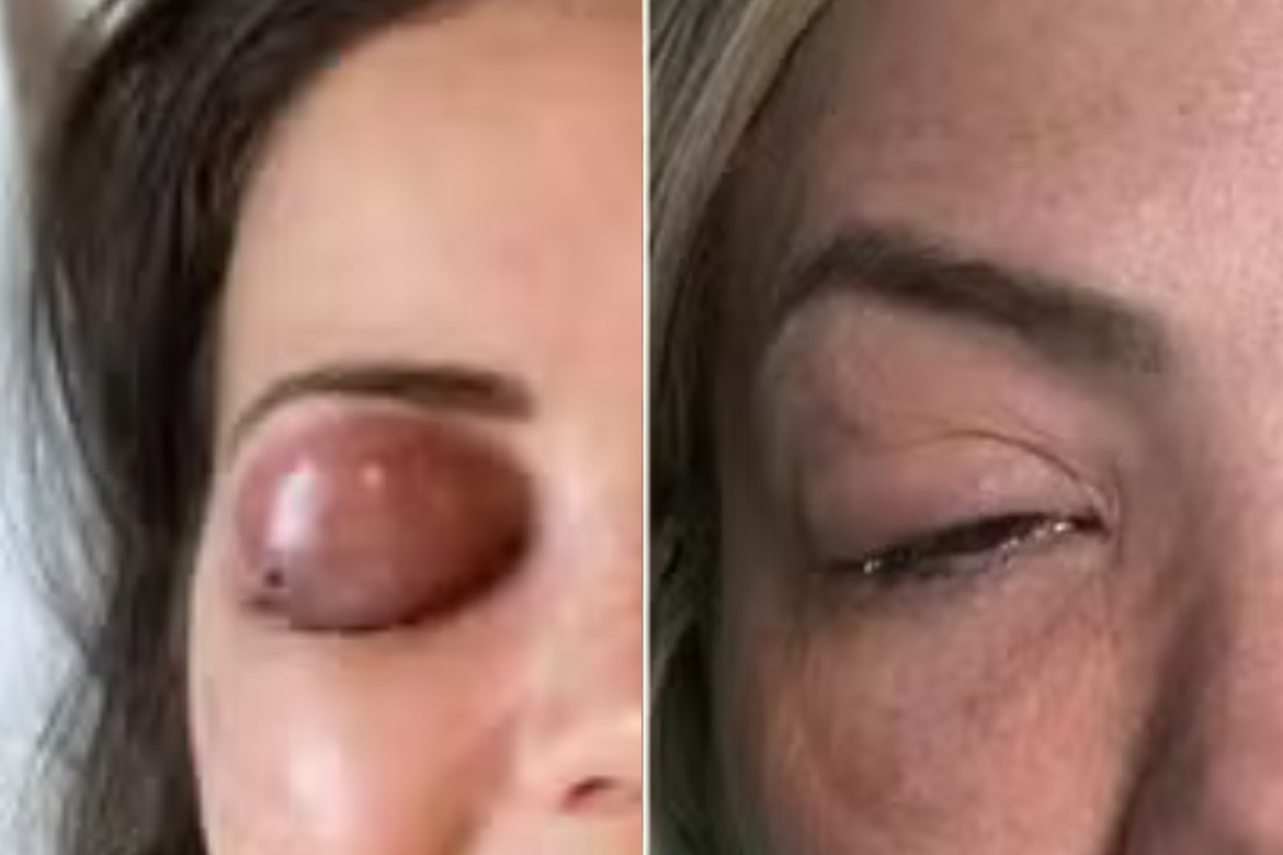 celulite-no-olho?-bacteria-de-sinusite,-espinha,-picadas-e-infeccao-no-dente-pode-causar-cegueira-e-morte