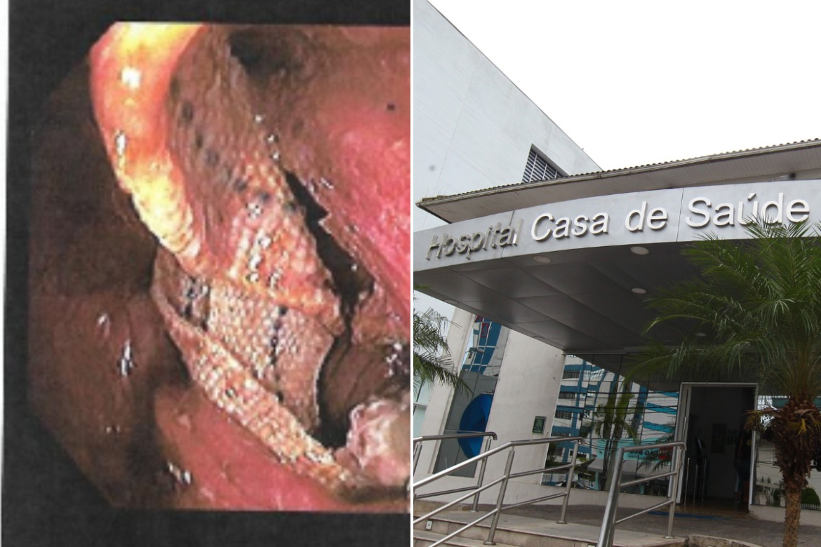 gaze-esquecida-em-cirurgia-deixa-idosa-em-coma-e-hospital-e-condenado-em-r$-245-mil