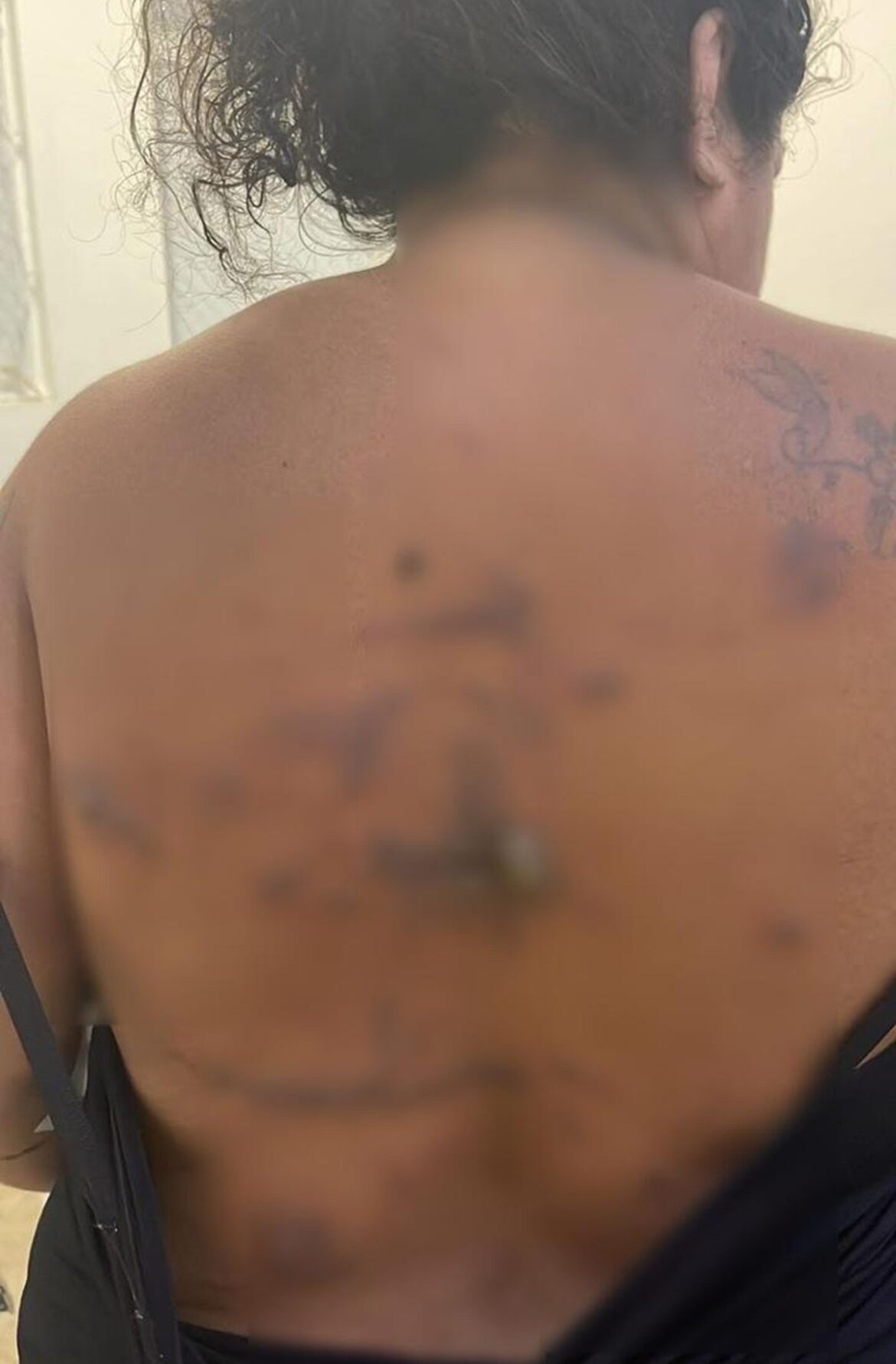 paciente-denuncia-queimaduras-durante-cesariana-realizada-em-hospital-de-arraial-do-cabo